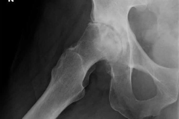 Röntgenbild einer schweren rechtsseitigen Hüftgelenksarthrose mit Hüftkopfeinbruch bei einem jüngeren 49-jährigen Mann.