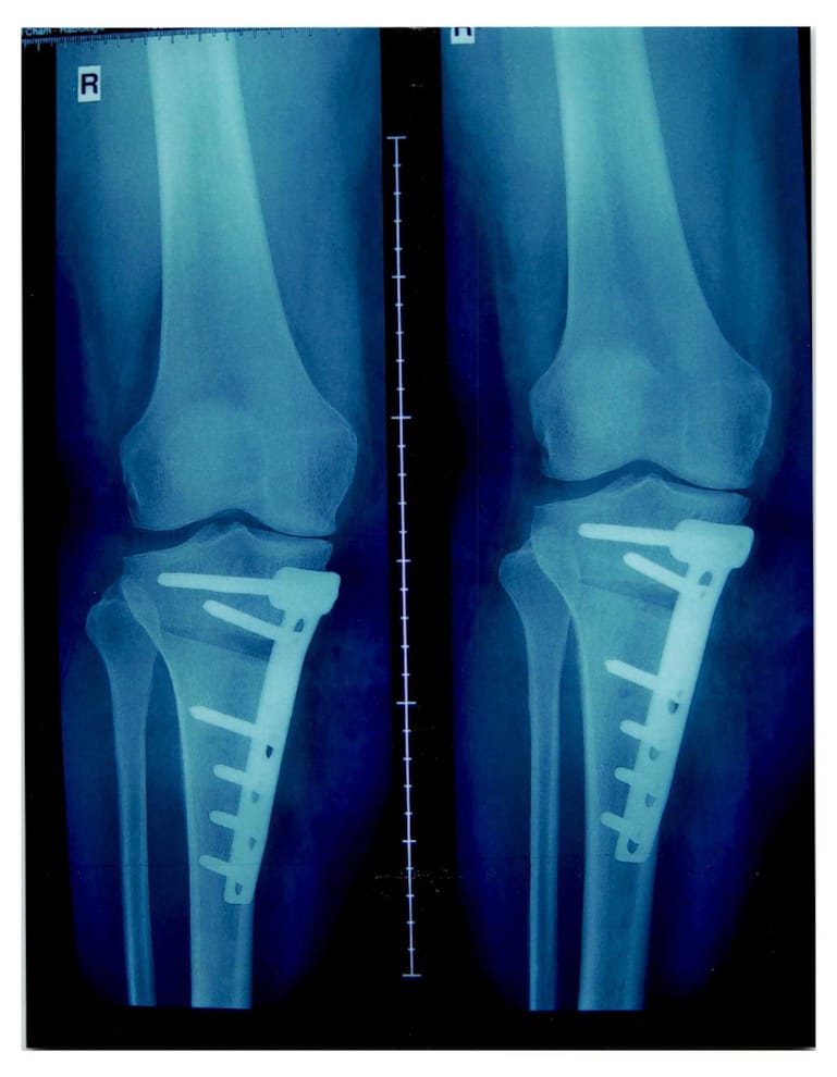 X Und O Bein Fehlstellungen Beinachsenkorrektur Hufte Knie Orthozentrum Cham Zug Schweiz Orthopadische Chirurgie Dr Med Rolf F Oetiker