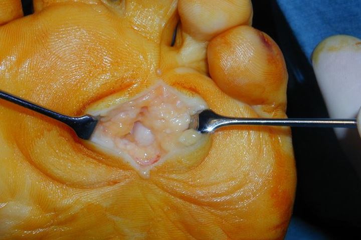 Bild eines Mortonneuroms bei von der Fusssohle her geöffnetem Fuss