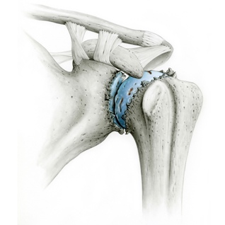Schultergelenksarthrose