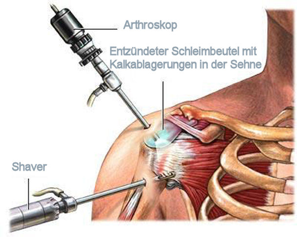 Schulterarthroskopie bei Tendinitis calcarea – Schematische Darstellung