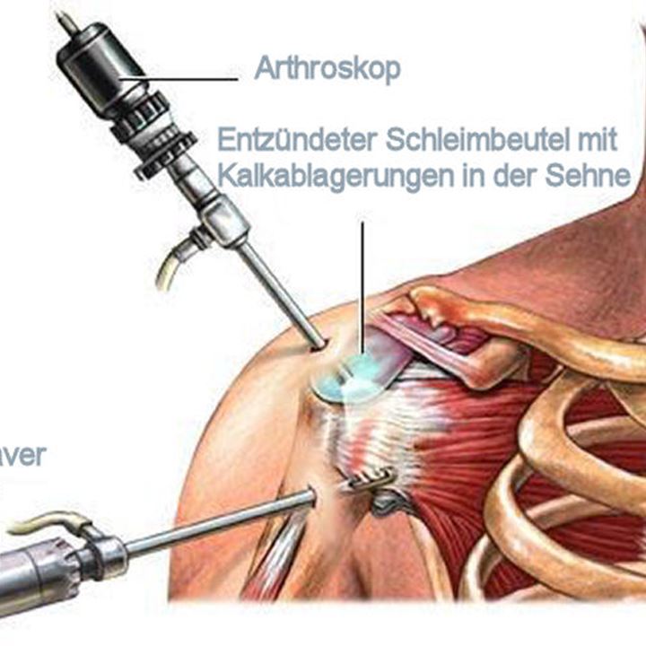 Schulterarthroskopie bei Tendinitis calcarea – Schematische Darstellung