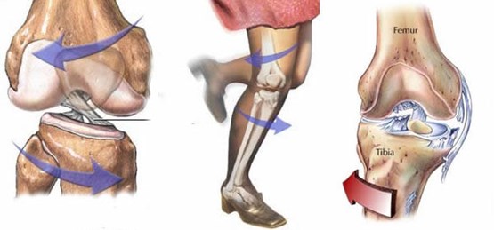 Kreuzbandrisse am Knie