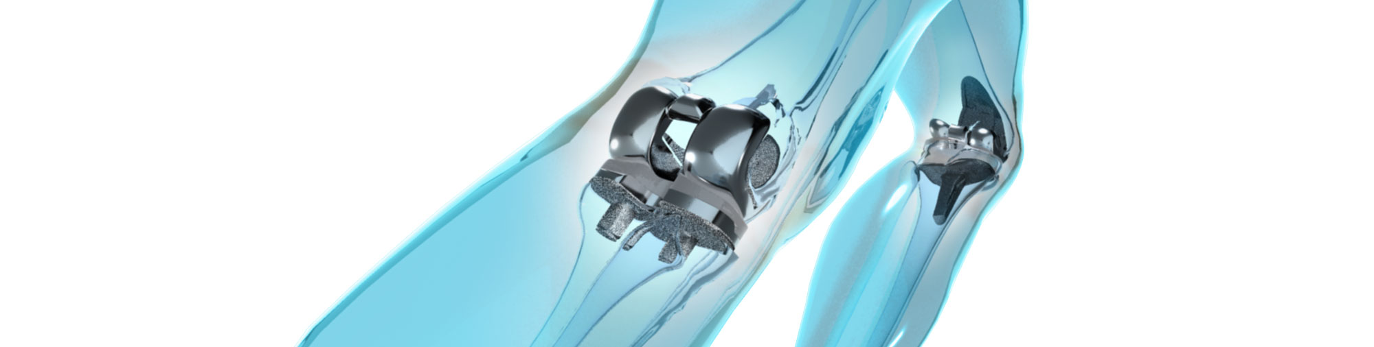 Kunstgelenkersatz am Knie