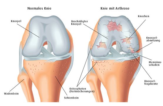 Kniearthrose - Kniegelenksarthrose - die Abnutzung im Kniegelenk
