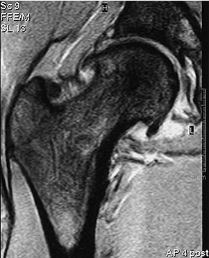Abb. 3: Magnetresonanztomographie der Hüfte rechts vor der Operation mit gut erkennbaren Randzacken am Hüftkopf, gleicher Patient wie Abb. 2.