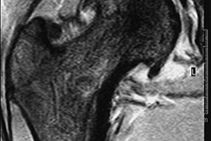 Abb. 3: Magnetresonanztomographie der Hüfte rechts vor der Operation mit gut erkennbaren Randzacken am Hüftkopf, gleicher Patient wie Abb. 2.