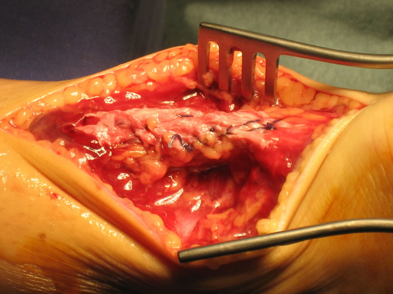 Rekonstruierte Achillessehne