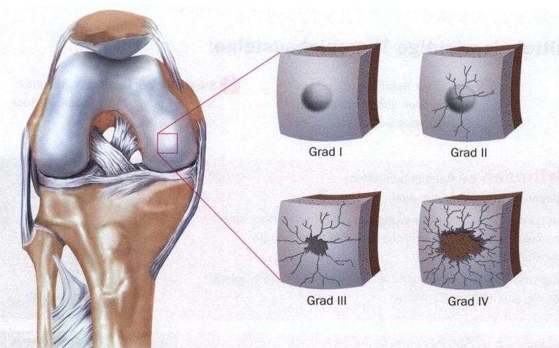 Kniespiegelung Kniearthroskopie Hufte Knie Orthozentrum Cham Zug Schweiz Orthopadische Chirurgie Dr Med Rolf F Oetiker