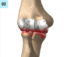 Arthrose des Ellbogens