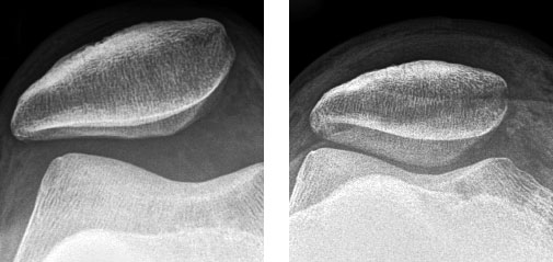 Patellaluxation (Ausrenken der Kniescheibe)