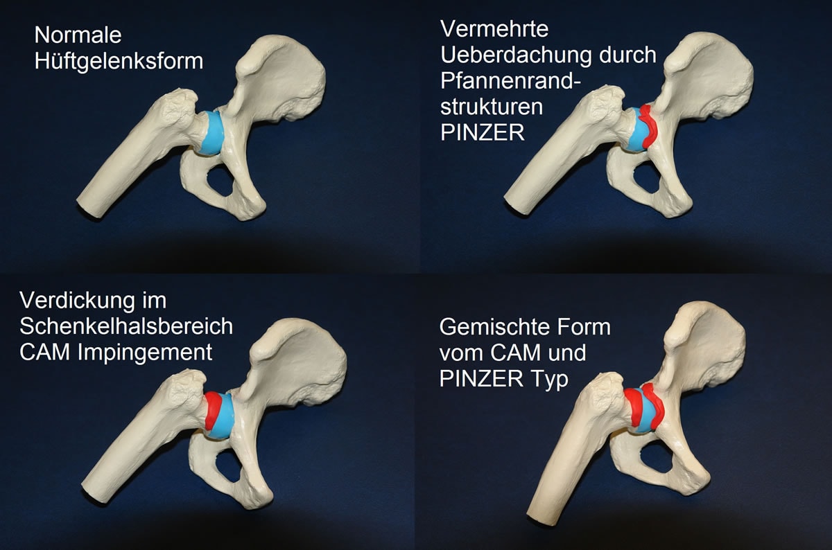 Die verschiedenen Varianten des Hüftimpingementsyndroms