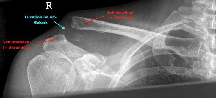Verletzungen des Schultereckgelenkes (AC-Luxation)