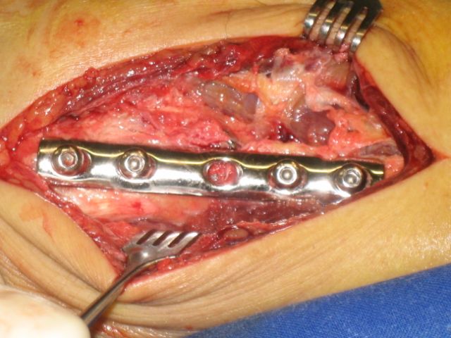 Operation Aussenknöchelbruch: nach Plattenfixation