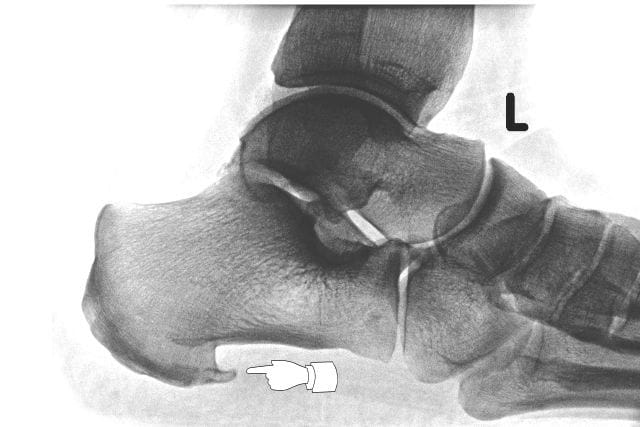 Fersensporn Fasziitis Plantaris Fuss Sprunggelenk Orthozentrum Cham Zug Schweiz Orthopadische Chirurgie Dr Med Rolf F Oetiker