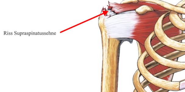 Schulter Ellbogen Hand Orthozentrum Cham Zug Schweiz Orthopadische Chirurgie Dr Med Rolf F Oetiker Schulter Ellbogen Hand Orthozentrum Cham Zug Schweiz Orthopadische Chirurgie Dr Med Rolf F Oetiker