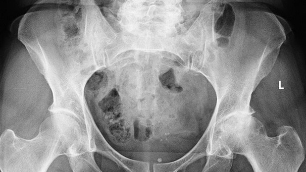 Röntgenbild Hüftgelenksarthrosen