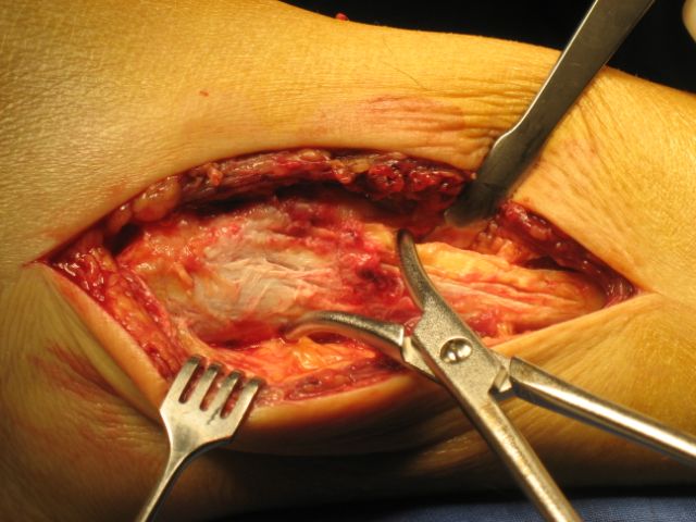 Operation Aussenknöchelbruch: nach Reposition