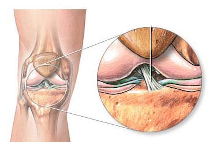 Kreuzbandriss Hufte Knie Orthozentrum Cham Zug Schweiz Orthopadische Chirurgie Dr Med Rolf F Oetiker Kreuzbandriss Hufte Knie Orthozentrum Cham Zug Schweiz Orthopadische Chirurgie Dr Med Rolf F Oetiker