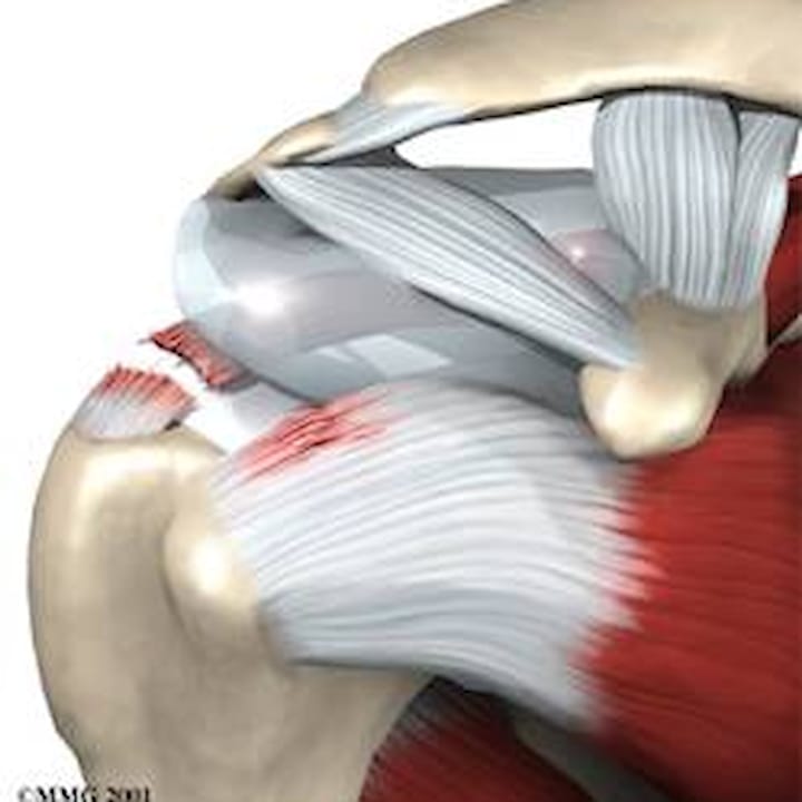 Rotatorenmanschettenruptur Und Impingementsyndrom Schulter Ellbogen Hand Orthozentrum Cham Zug Schweiz Orthopadische Chirurgie Dr Med Rolf F Oetiker Rotatorenmanschettenruptur Und Impingementsyndrom Schulter Ellbogen Hand Orthozentrum Cham Zug Schweiz Orthopadische Chirurgie Dr Med Rolf F Oetiker