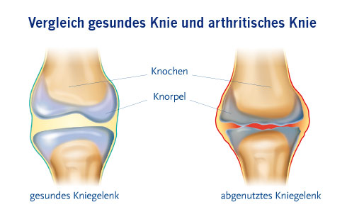 Arthrose des Kniegelenkes (Gonarthrose)