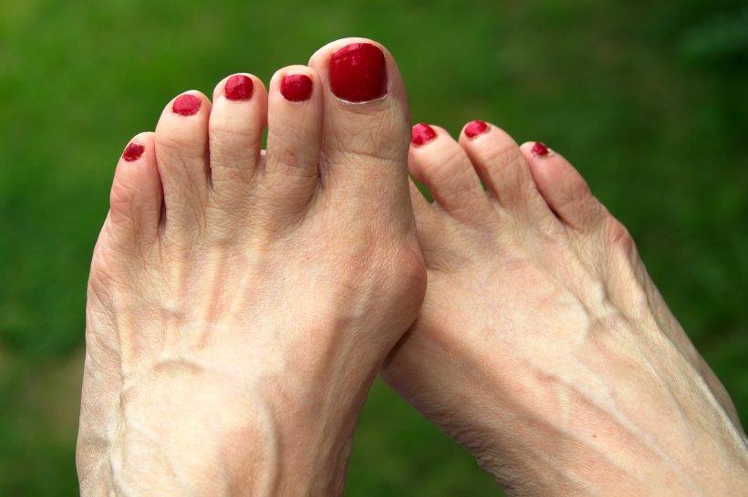 Hallux valgus