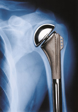 Herkömmliche Schultertotalprothese