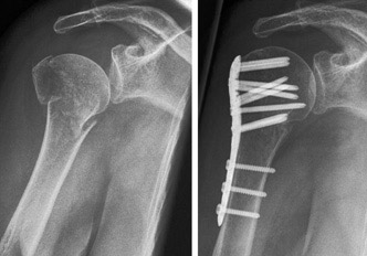 Schultergelenksnahe Knochenbrüche