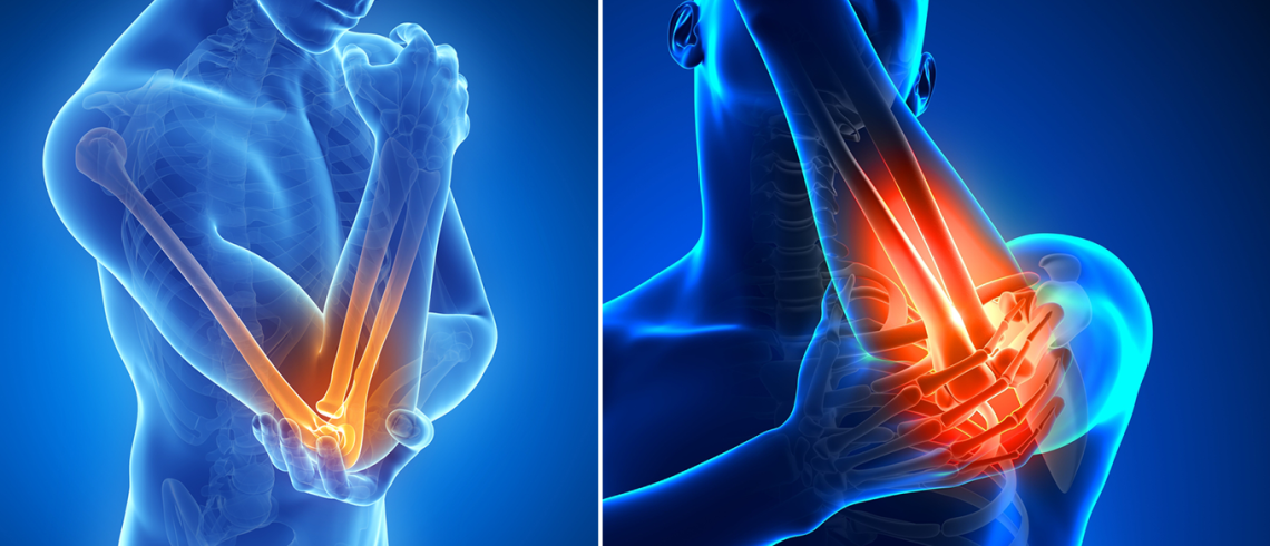 Tennis- und Golferellbogen (Epicondylitis)