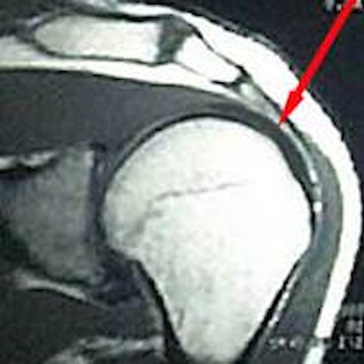 Rotatorenmanschettenruptur Und Impingementsyndrom Schulter Ellbogen Hand Orthozentrum Cham Zug Schweiz Orthopadische Chirurgie Dr Med Rolf F Oetiker Rotatorenmanschettenruptur Und Impingementsyndrom Schulter Ellbogen Hand Orthozentrum Cham Zug Schweiz Orthopadische Chirurgie Dr Med Rolf F Oetiker