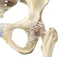 Arthrose des Hüftgelenkes (Coxarthrose)