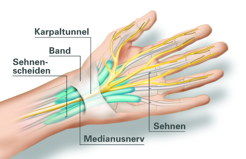 Carpaltunnelsyndrom