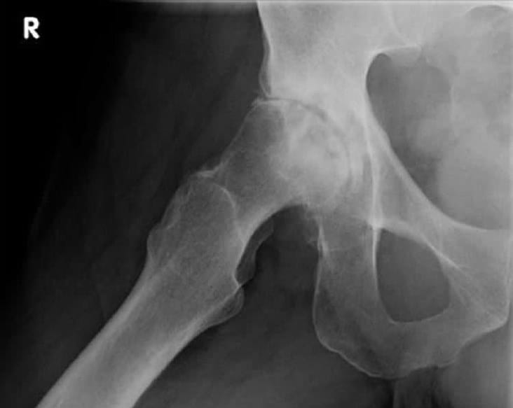 Coxarthrose Huftgelenksarthrose Hufte Knie Orthozentrum Cham Zug Schweiz Orthopadische Chirurgie Dr Med Rolf F Oetiker