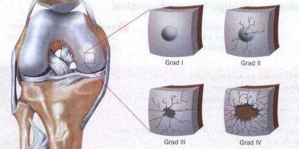 Knorpelschäden am Kniegelenk