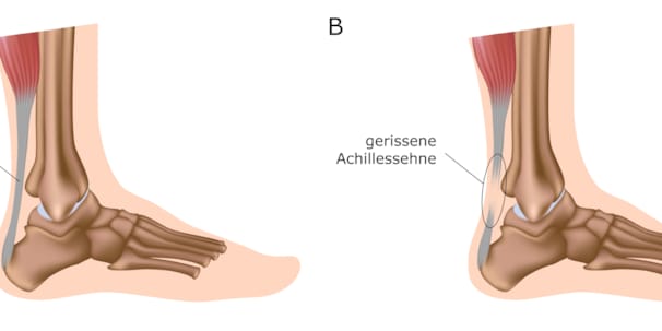 dicke achillessehne was tun