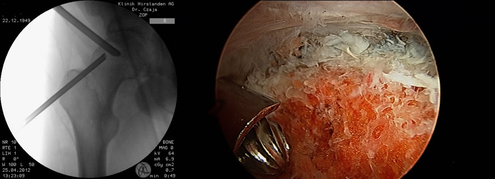 Bildwandlerkontrolliert werden Knochenverdickungen abgefräst (sog. Schenkelhalstaillierung)
