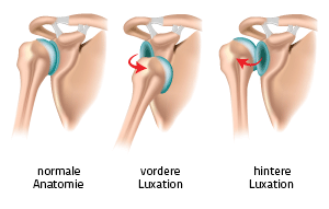 Ausrenkung der Schulter (Schulterluxation) und Schulterinstabilität