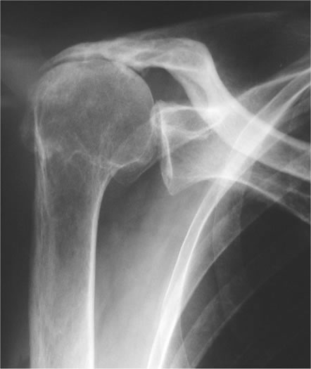 Schwere Schultergelenksarthrose mit Hochstand des Oberarmknochenkopfes aufgrund einer degenerativen Abnutzung der Rotatorenmanschette (sog. Cuffarthropathie)